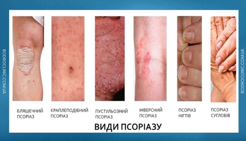 Чим відрізняються псоріаз і екзема, пояснила лікарка - Дім