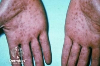 Де і як беруть кров на сифіліс: процес аналізу та що варто знати?