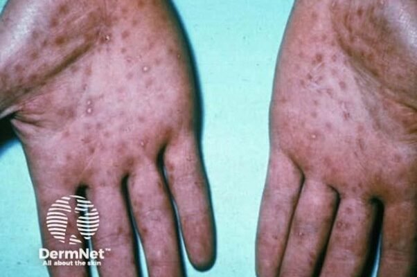 Де і як беруть кров на сифіліс: процес аналізу та що варто знати?