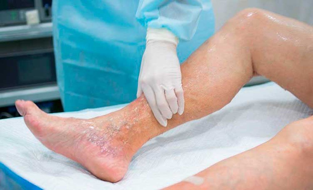 Ефективне лікування варикозу