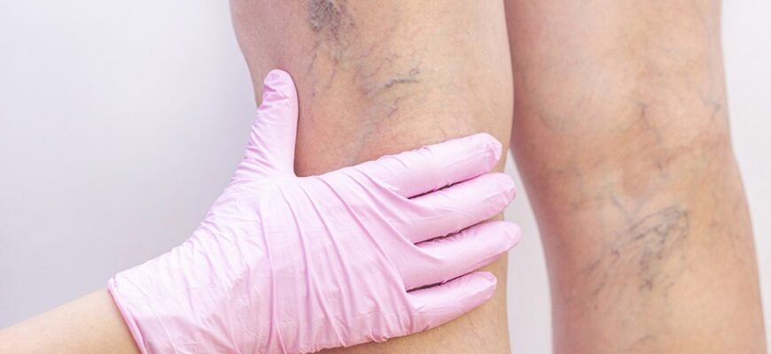 Ефективне лікування варикозу: методи, які дійсно працюють