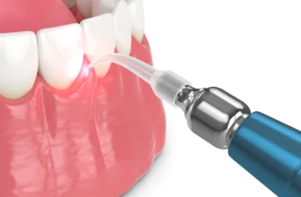 Лазерна імплантація зубів: сучасні досягнення в стоматології для вас