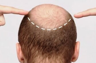 Лікування облисіння: FUE Artas – сучасний метод відновлення волосся