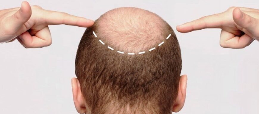 Лікування облисіння: FUE Artas – сучасний метод відновлення волосся