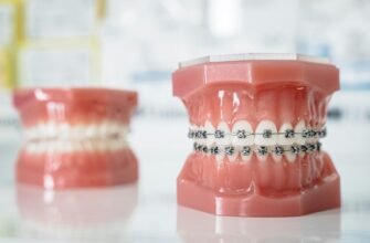 Вініри чи брекети: оберіть найкращий шлях до ідеальної посмішки