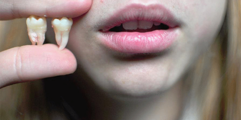 Значення сну: видалення зуба уві сні та його символіка в житті