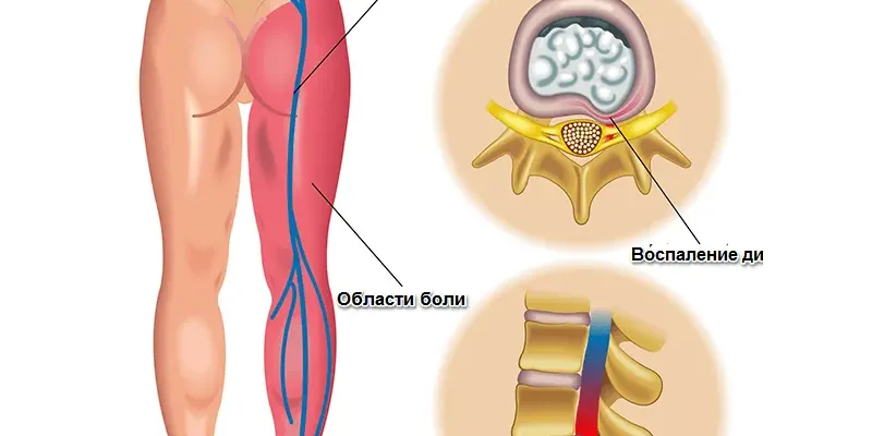 Чи може біль у спині бути викликаний нервовими перевантаженнями?