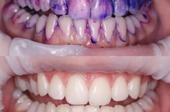 Ефективна чистка зубів від каменю: ціна і якість процедур 2023