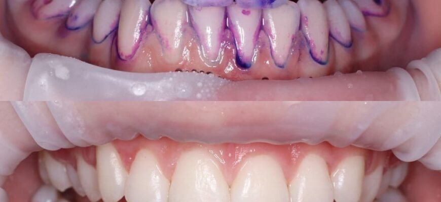 Ефективна чистка зубів від каменю: ціна і якість процедур 2023