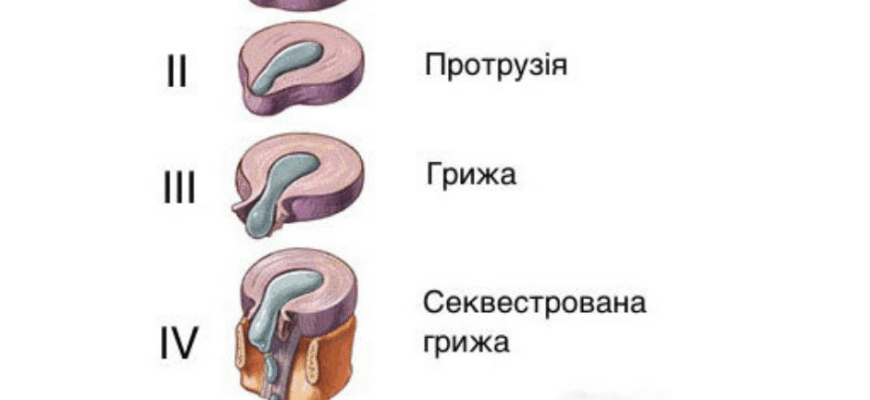 Протрузія і грижа: основні відмінності та як їх розпізнати