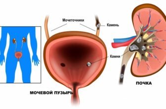 Причини підвищення рівня сечової кислоти: основні фактори та поради