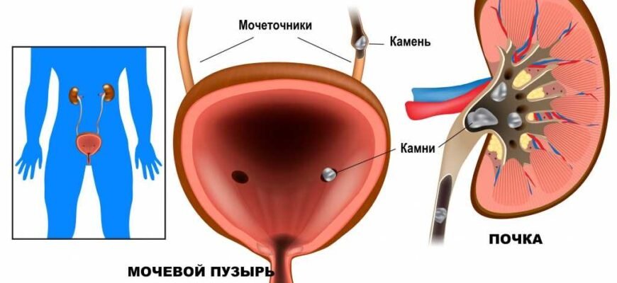 Причини підвищення рівня сечової кислоти: основні фактори та поради