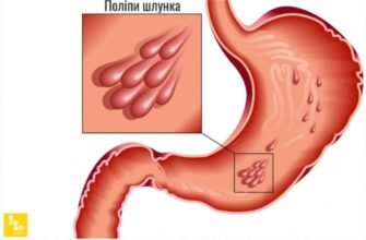 Причини виникнення поліпів у шлунку: основні фактори та ризики