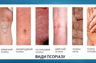 Як відрізнити псоріаз від дерматиту: практичні поради та ознаки