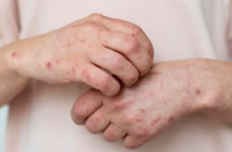 Як виглядає нервова алергія: ознаки, симптоми та лікування