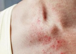 Як виглядає висип від нервів: симптоми, фото та поради лікування