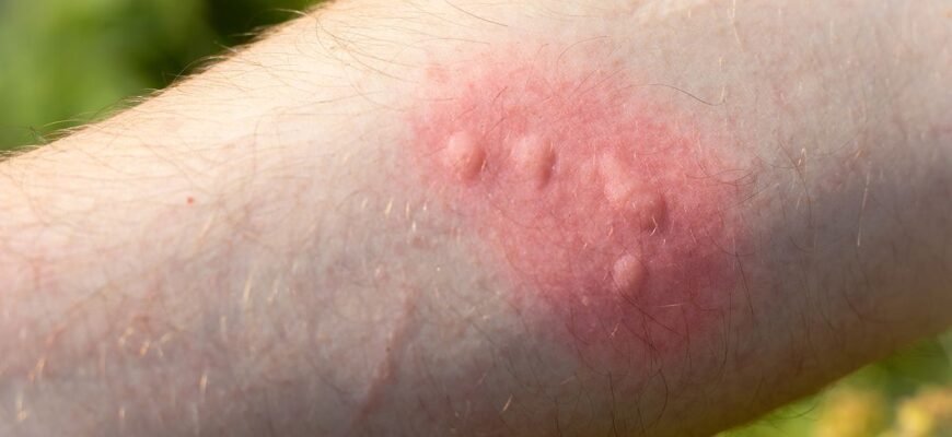 Як запобігти та лікувати опіки від кропиви: поради та рекомендації