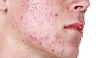 Підшкірний кліщ демодекс на обличчі: лікування, ознаки, як виглядає