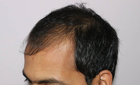 Пересадка волосся - ціна процедури в Києві ✔️ ANACOSMA